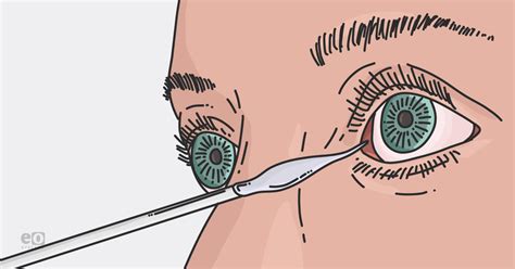 corneal-cotton or saline drop will blink test positive|testing for corneal sensitivity.